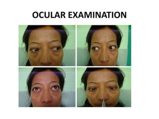 OCULAR EXAMINATION
 