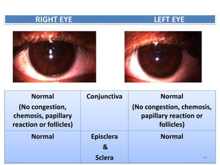 Normal
(No congestion,
chemosis, papillary
reaction or follicles)
Conjunctiva Normal
(No congestion, chemosis,
papillary reaction or
follicles)
Normal Episclera
&
Sclera
Normal
RIGHT EYE LEFT EYE
68
 