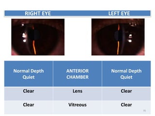 Normal Depth
Quiet
ANTERIOR
CHAMBER
Normal Depth
Quiet
Clear Lens Clear
Clear Vitreous Clear
RIGHT EYE LEFT EYE
70
 