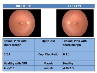 Round, Pink with
sharp margin
Optic Disc Round, Pink with
sharp margin
0.2:1 Cup: Disc Ratio 0.2:1
Healthy with GFR Macula Healthy
A:V=2:3 Vessels A:V=2:3
RIGHT EYE LEFT EYE
71
 
