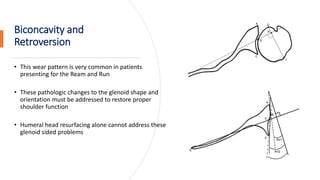Ream and run patient guide | PPTX