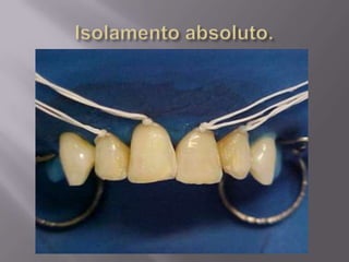 Reanatomização com resina composta.