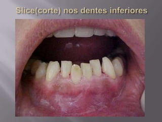 Reanatomização com resina composta.