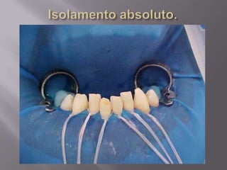 Reanatomização com resina composta.