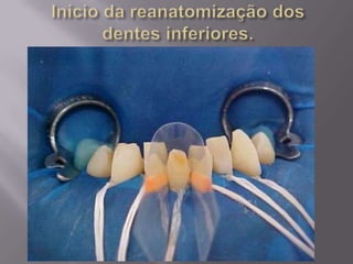 Reanatomização com resina composta.