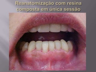 Reanatomização com resina composta.