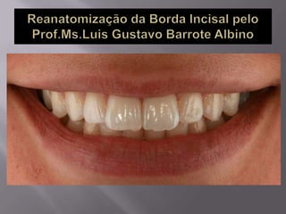Reanatomização da borda incisal pelo Prof.Ms.Luis Gustavo Barrote Albino.