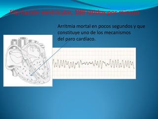Fibrilación ventricular, 188 latidos por minuto
                 Arritmia mortal en pocos segundos y que
                 ...