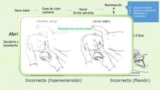 Nace bebé
Cuna de calor
radiante
Secar
Evitar pérdida
de calor
Reanimación
A
B
C
A. Liberar vía aérea
B. Iniciar la respiración
C. Mantener la
circulación
Abrir vía aérea
Decúbito dorsal o lateral y cuello
levemente extendido
Elevar 1.5-2.5cm
Abundantes secreciones
 