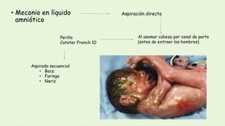 • Meconio en líquido
amniótico
Aspiración directa
Al asomar cabeza por canal de parto
(antes de extraer los hombros)
Perilla
Cateter French 10
Aspirado secuencial
• Boca
• Faringe
• Nariz
 