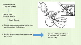 Niños deprimidos
c/ meconio espeso
Cuna de calor
Antes de secarlo
 Eliminar meconio residual de hipofaringe
succionado bajo visión directa
 Intubar traquea y succionar meconio de
vía inferior
Seguir 2pasos
• Succión continua mientras se
va retirando. No exceder
mas de 5 seg
 