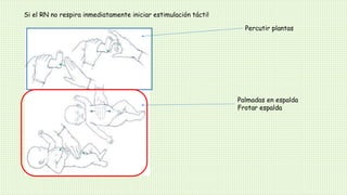 Si el RN no respira inmediatamente iniciar estimulación táctil
Percutir plantas
Palmadas en espalda
Frotar espalda
 