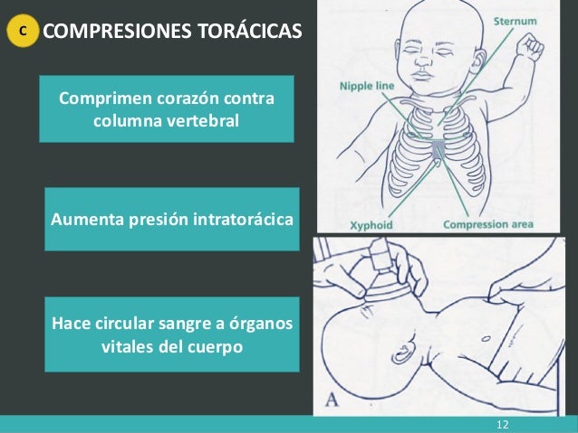 Reanimación neonatal