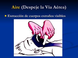 Extracción de cuerpos extraños visibles Aire  (Despeje la Vía Aérea) 