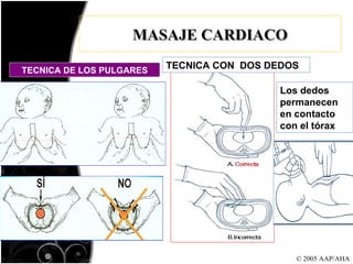 © 2005 AAP/AHA MASAJE CARDIACO TECNICA DE LOS PULGARES TECNICA CON  DOS DEDOS Los dedos permanecen en contacto con el tórax 