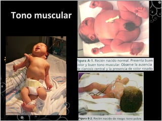 Tono muscular 