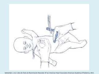 Kattwinkel J. et al. Libro de Texto de Reanimación Neonatal. 6º ed. American Heart Asocciaton-American Academy of Pediatrics; 2011.
 