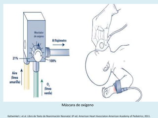 Máscara de oxígeno
Kattwinkel J. et al. Libro de Texto de Reanimación Neonatal. 6º ed. American Heart Asocciaton-American Academy of Pediatrics; 2011.
 