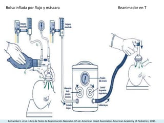 Bolsa inflada por flujo y máscara Reanimador en T
Kattwinkel J. et al. Libro de Texto de Reanimación Neonatal. 6º ed. American Heart Asocciaton-American Academy of Pediatrics; 2011.
 