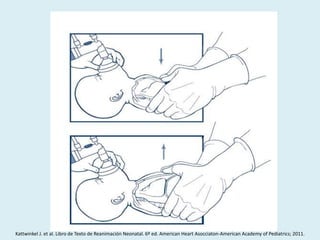 Kattwinkel J. et al. Libro de Texto de Reanimación Neonatal. 6º ed. American Heart Asocciaton-American Academy of Pediatrics; 2011.
 