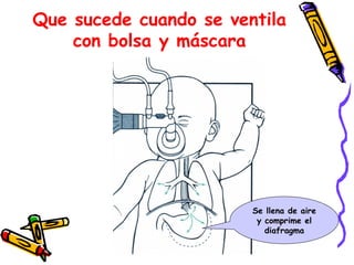 Que sucede cuando se ventila
con bolsa y máscara
Se llena de aire
y comprime el
diafragma
 