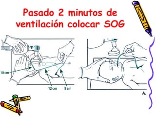 Pasado 2 minutos de
ventilación colocar SOG
 