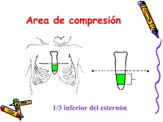Area de compresión
1/3 inferior del esternón
 