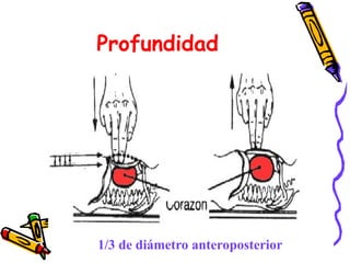 Profundidad
1/3 de diámetro anteroposterior
 