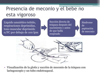 Presencia de meconio y el bebe no
esta vigoroso
• Visualización de la glotis y succión de meconio de la tráquea con
laringoscopio y un tubo endotraqueal.
Liquido amniótico teñido,
respiraciones deprimidas,
tono muscular deprimido
o/FC por debajo de 100 lpm
Succión directa de
tráquea después del
nacimiento y antes
de que halla
respirado
Síndrome
de
aspiración
de meconio
 