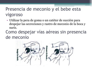 Presencia de meconio y el bebe esta
vigoroso
• Utilizar la pera de goma o un catéter de succión para
despejar las secreciones y rastro de meconio de la boca y
nariz.
Como despejar vías aéreas sin presencia
de meconio
 