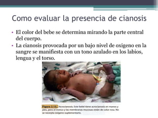 Como evaluar la presencia de cianosis
• El color del bebe se determina mirando la parte central
del cuerpo.
• La cianosis provocada por un bajo nivel de oxigeno en la
sangre se manifiesta con un tono azulado en los labios,
lengua y el torso.
 