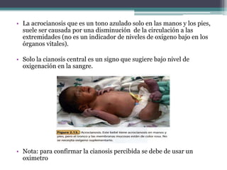 • La acrocianosis que es un tono azulado solo en las manos y los pies,
suele ser causada por una disminución de la circulación a las
extremidades (no es un indicador de niveles de oxigeno bajo en los
órganos vitales).
• Solo la cianosis central es un signo que sugiere bajo nivel de
oxigenación en la sangre.
• Nota: para confirmar la cianosis percibida se debe de usar un
oximetro
 