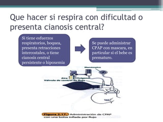 Que hacer si respira con dificultad o
presenta cianosis central?
Si tiene esfuerzos
respiratorios, boquea,
presenta retracciones
intercostales, o tiene
cianosis central
persistente o hipoxemia
Se puede administrar
CPAP con mascara, en
particular si el bebe es
prematuro.
 