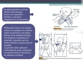 Se aplica presión en tercio
inferior del esternón
(entre en el apéndice
xifoides y una línea
imaginaria en los pezones)
Rodeando el torso con ambas
manos, los pulgares se colocan
sobre el esternón y los dedos
debajo de la espalda del bebe.
Los pulgares comprimen el
esternón, mientras que los
dedos brindan el apoyo para la
espalda.
La presión debe aplicarse
verticalmente para comprimir
el corazón entre el esternón y
la columna vertebral
 