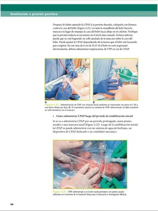 Ventilación a presión positiva
Después de haber ajustado la CPAP a la presión deseada, colóquela con firmeza
contra la cara del bebé (Figura 4.21). Levante la mandíbula del bebé hacia la
máscara en lugar de empujar la cara del bebé hacia abajo en el colchón. Verifique
que la presión todavía se encuentre en el nivel seleccionado. Si fuera inferior,
puede que no esté logrando un sello ajustado de la máscara sobre la cara del
bebé. Puede ajustar la CPAP dependiendo de la fuerza que el bebé esté haciendo
para respirar. No use más de 8 cm de H20. Si el bebé no está respirando
efectivamente, deberá administrar respiraciones de VPP en vez de CPAP.
A B
F ig u r í 4.2 Administración de CPAP con máscara facial mediante un reanimador con pieza enT (A) y
una bolsa inflada por flujo (B). El manómetro muestra la cantidad de CPAP administrada. Se debe mantener
un sello hermético con la máscara.
• Cómo administrar CPAP luego del período de estabilización inicial
Si se va a administrar CPAP por un período prolongado, usará puntas
nasales o una máscara nasal (Figura 4.22). Luego de la estabilización inicial,
la CPAP se puede administrar con un sistema de agua de burbujas, un
dispositivo de CPAP dedicado o un ventilador mecánico.
Ficj ra 4.22. CPAP administrada a un recién nacido prematuro con puntas nasales.
(Utilizada con el permiso de la Fundación Mayo para la Educación e Investigación Médica).
ERRNVPHGLFRVRUJ
 