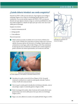 ¿Cuándo debería introducir una sonda orogástrica?
Durante la CPAP o VPP con una máscara, el gas ingresa en el esófago y
estómago (Figura 4.23). El gas en el estómago puede interferir con la
ventilación. Si un recién nacido requiere de CPAP o VPP con máscara
durante más que algunos minutos, tenga en cuenta la posibilidad de colocar
una sonda orogástrica y dejarla sin tapar para que actúe como una vía de
salida para el estómago.
Equipos necesarios:
• Sonda de alimentación 8F
• Jeringa grande
• Cinta adhesiva
Pasos de inserción:
O Mida la distancia desde el caballete de la nariz hasta el lóbulo de la
oreja y desde el lóbulo de la oreja hasta un punto medio entre elproceso
xifoides (la punta inferior del esternón) y el ombligo. Note la marca en
centímetros en este lugar, sobre el tubo (Figura 4.24). Para minimizar
la interrupción de la ventilación, la medición de la sonda orogástrica
puede calcularse de manera aproximada, con la máscara colocada.
F ig u ra 4.2' Medición de la profundidad de inserción correcta para
una sonda orogástrica. En este ejemplo, la sonda debe introducirse 28 cm.
o Introduzca la sonda a través de la boca (Figura 4.25A). Se puede
reiniciar la ventilación en cuanto la sonda quede colocada. Vuelva a
evaluar el sello de la máscara facial.
e Una vez que la sonda quede introducida a la distancia deseada, conecte
una jeringa y aspire el contenido gástrico (Figura 4.25B).
O Retire la jeringa de la sonda y deje el extremo de la sonda abierto para
proporcionar una vía de salida para el aire que entra en el estómago
(Figura 4.25C).
© Pegue con cinta adhesiva la sonda en la mejilla del bebé (Figura 4.25D).
LECCIÓN 4
Exceso de gas en el
estómago de la ventilación con
máscara de oxígeno
89
ERRNVPHGLFRVRUJ
 