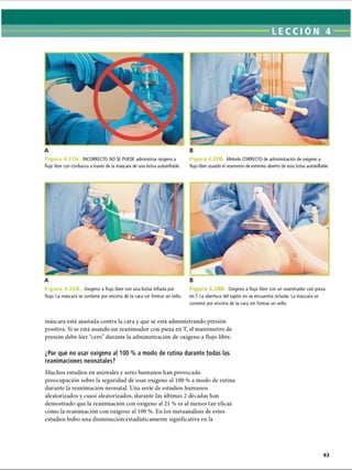 Figura 4 27A INCORRECTO. NO SE PUEDE administrar oxígeno a
flujo libre con confianza a través de la máscara de una bolsa autoinflable.
Ficju 4.271 Método CORRECTO de administración de oxígeno a
flujo libre usando el reservorio de extremo abierto de esta bolsa autoinflable.
F ig u r i 4.28A Oxígeno a flujo libre con una bolsa inflada por
flujo. La máscara se sostiene por encima de la cara sin formar un sello.
Oxígeno a flujo libre con un reanimador con pieza
en T. La abertura del tapón no se encuentra ocluida. La máscara se
sostiene por encima de la cara sin formar un sello.
máscara está ajustada contra la cara y que se está administrando presión
positiva. Si se está usando un reanimador con pieza en T, el manómetro de
presión debe leer “cero” durante la administración de oxígeno a flujo libre.
¿Por qué no usar oxígeno al 100 % a modo de rutina durante todas las
reanimaciones neonatales?
Muchos estudios en animales y seres humanos han provocado
preocupación sobre la seguridad de usar oxígeno al 100 % a modo de rutina
durante la reanimación neonatal. Una serie de estudios humanos
aleatorizados y cuasi aleatorizados, durante las últimas 2 décadas han
demostrado que la reanimación con oxígeno al 21 % es al menos tan eficaz
como la reanimación con oxígeno al 100 %. En los metaanálisis de estos
estudios hubo una disminución estadísticamente significativa en la
ERRNVPHGLFRVRUJ
 