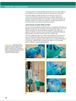 Ventilación a presión positiva
cara del paciente. El escape ajustable permite que el exceso de gas salga en
vez de inflar en exceso la bolsa o que este sea forzado hacia el paciente.
Las bolsas infladas por flujo suelen tener un sitio para conectar un
manómetro. El sitio de conexión suele estar cerca de la salida para el
paciente. El manómetro debe estar conectado o el sitio será una fuente de
pérdida y la bolsa no se inflará correctamente. También puede haber una
válvula de liberación de presión (válvula de disparo).
¿Cómo funciona una bolsa inflada por flujo?
Para que una bolsa inflada por flujo funcione correctamente, debe haber un
flujo de aire adecuado de una fuente y un sistema sellado (Figura 4A.5). El
inflado de la bolsa se controla mediante el equilibrio entre el gas que
ingresa en la bolsa, el gas que escapa a través de una válvula de control de
flujo ajustable y el gas que escapa a través de la salida de gas.
Una bolsa inflada por flujo no se inflará adecuadamente si la máscara no
está correctamente sellada; el flujo proveniente de la fuente de gas no es
suficiente, está desconectado o está ocluido; si hay un orificio en la bolsa; si
la válvula de control de flujo está demasiado abierta; o si se ha dejado
abierto el sitio de conexión del manómetro.
Figura 4A.5. Razones para inflado
insuficiente de una bolsa inflada por flujo:
(A) sello de la máscara inadecuado con
pérdida, (B) entrada de gas insuficiente, (C)
orificio en la bolsa, (D) válvula de control de
flujo demasiado abierta, (E) sitio de
conexión del manómetro abierto.
104
ERRNVPHGLFRVRUJ
 