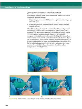 Ventilación a presión positiva
¿Cómo ajusta el inflado de una bolsa inflada por flujo?
Hay 2 formas en las que puede ajustar la presión de la bolsa y por tanto el
volumen de inflado de la bolsa.
• Al ajustar el gas proveniente del flujómetro, regula la cantidad de gas que
entra en la bolsa.
• Al ajustar la válvula de control de flujo de la bolsa, regula cuánto gas
escapa de la bolsa.
El medidor de flujo y la válvula de control de flujo deben configurarse de
modo tal que la bolsa se infle hasta un punto en que sea cómoda de
manipular y no se desinfle del todo con cada respiración asistida (Figura
4A.7A). Una bolsa demasiado inflada (Figura 4A.7B) es difícil de
manipular y podría administrar alta presión al bebé; podría desarrollarse
un neumotorax u otra pérdida de aire. Una bolsa inflada de menos (Figura
4A.7C) hace que sea difícil alcanzar la presión de insuflación deseada. Con
la práctica, podrá hacer los ajustes necesarios para lograr un equilibrio. Si
hay un sellado adecuado entre la cara del bebé y la máscara, debe poder
mantener la cantidad de inflado adecuada con el medidor de flujo
configurado en entre 8 y 10 1/min.
B C
Figu ra 4A.7. Inflado correcto de la bolsa inflada por flujo (A), inflado en exceso (B) e inflado insuficiente (C)
106
ERRNVPHGLFRVRUJ
 