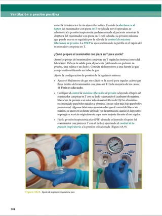 Ventilación a presión positiva
conecta la máscara o la vía aérea alternativa. Cuando la abertura en el
tapón del reanimador con pieza en T es ocluida por el operador, se
administra la presión inspiratoria predeterminada al paciente mientras la
abertura del reanimador con pieza en T esté ocluida. La presión máxima
que puede usarse es regulada por la válvula de control de máxima
liberación de presión. La PEEP se ajusta utilizando la perilla en el tapón del
reanimador con pieza en T.
¿Cómo prepara el reanimador con pieza en T para usarlo?
Arme las piezas del reanimador con pieza en T según las instrucciones del
fabricante. Ocluya la salida para el paciente (utilizando un pulmón de
prueba, una palma o un dedo). Conecte el dispositivo a una fuente de gas
comprimido utilizando un tubo de gas.
Ajuste la configuración de presión de la siguiente manera:
• Ajuste el flujómetro de gas mezclado en la pared para regular cuánto gas
fluye dentro del reanimador con pieza en T. En la mayoría de los casos,
10 1/min es adecuado.
• Configure el control de máxima liberación depresión ocluyendo el tapón del
reanimador con pieza en T con su dedo y ajustando el cuadrante de máxima
liberación de presión a un valor seleccionado (40 cm de H20 es el máximo
recomendado para bebés nacidos a término, con un valor más bajo para bebés
prematuros). Algunos fabricantes recomiendan que el control de liberación
máxima se ajuste en un límite definido por la institución cuando el dispositivo
se ponga en servicio originalmente y que no se reajuste durante el uso regular.
• Fije la presión inspiratoria pico (PIP) deseada ocluyendo el tapón del
reanimador con pieza en T con el dedo y ajustando el control de la
presión inspiratoria a la presión seleccionada (Figura 4A.9).
F ie Ajuste de la presión inspiratoria pico
108
ERRNVPHGLFRVRUJ
 