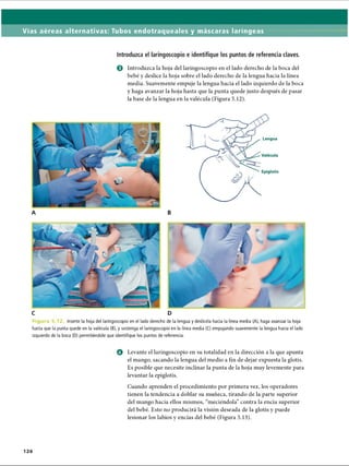 Vías aéreas alternativas: Tubos endotraqueales y máscaras laríngeas
Introduzca el laringoscopio e identifique los puntos de referencia claves.
0 Introduzca la hoja del laringoscopio en el lado derecho de la boca del
bebé y deslice la hoja sobre el lado derecho de la lengua hacia la línea
media. Suavemente empuje la lengua hacia el lado izquierdo de la boca
y haga avanzar la hoja hasta que la punta quede justo después de pasar
la base de la lengua en la valécula (Figura 5.12).
F i g u r a b . M Inserte la hoja del laringoscopio en el lado derecho de la lengua y deslícela hacia la línea media (A), haga avanzar la hoja
hasta que la punta quede en la valécula (B), y sostenga el laringoscopio en la línea media (C) empujando suavemente la lengua hacia el lado
izquierdo de la boca (D) permitiéndole que identifique los puntos de referencia.
o Levante el laringoscopio en su totalidad en la dirección a la que apunta
el mango, sacando la lengua del medio a fin de dejar expuesta la glotis.
Es posible que necesite inclinar la punta de la hoja muy levemente para
levantar la epiglotis.
Cuando aprenden el procedimiento por primera vez, los operadores
tienen la tendencia a doblar su muñeca, tirando de la parte superior
del mango hacia ellos mismos, “meciéndola” contra la encía superior
del bebé. Esto no producirá la visión deseada de la glotis y puede
lesionar los labios y encías del bebé (Figura 5.13).
126
ERRNVPHGLFRVRUJ
 
