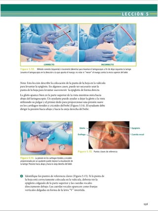 Figura 5 Método correcto (izquierda) e incorrecto (derecha) para levantar el laringoscopio a fin de dejar expuesta la laringe.
Levante el laringoscopio en la dirección a la que apunta el mango; no rotar ni mecer el mango contra la encía superior del bebé.
Nota: Esta lección describe la colocación de la punta de la hoja en la valécula
para levantar la epiglotis. En algunos casos, puede ser necesario usar la
punta de la hoja para levantar suavemente la epiglotis de forma directa.
La glotis aparece bien en la parte superior de la vista mientras mira hacia
abajo del laringoscopio. Un ayudante puede ayudar a dejar la glotis a la vista
utilizando su pulgar y el primer dedo para proporcionar una presión suave
en los cartílagos tiroides y cricoides del bebé (Figura 5.14). El ayudante debe
dirigir la presión hacia abajo y hacia la oreja derecha del bebé.
La presión en los cartílagos tiroides y cricoides
proporcionada por un ayudante puede mejorar la visualización de
la laringe. Presione hacia abajo y hacia la oreja derecha del bebé.
Glotis
Esófago
Epiglotis
~~ Cuerda vocal
Figura 5. Puntos claves de referencia
© Identifique los puntos de referencia claves (Figura 5.15). Si la punta de
la hoja está correctamente colocada en la valécula, debería ver la
epiglotis colgando de la parte superior y las cuerdas vocales
directamente debajo. Las cuerdas vocales aparecen como franjas
verticales delgadas en forma de la letra “V” invertida.
127
ERRNVPHGLFRVRUJ
 