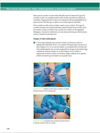 Vías aéreas alternativas: Tubos endotraqueales y máscaras laríngeas
hasta que las cuerdas vocales estén ubicadas entre las líneas de la guía de
cuerdas vocales. Su ayudante puede sentir el tubo pasando por debajo de
sus dedos. Tenga presente la marca en centímetros de la profundidad en la
parte exterior del tubo que se alinea con el labio superior del bebé.
Si las cuerdas vocales están cerradas, espere a que se abran. No toque la
cuerdas cerradas con la punta del tubo y jamás intente forzar el tubo entre
las cuerdas vocales cerradas. Si las cuerdas no se abren en 30 segundos,
deténgase y retome la ventilación con una máscara hasta que esté listo para
volver a intentar la introducción.
Asegure el tubo endotraqueal.
o Use la mano derecha para sostener el tubo con firmeza contra el
paladar duro del bebé. Retire con cuidado el laringoscopio sin mover el
tubo (Figura 5.21). Si se usó un estilete, un ayudante debe retirarlo del
tubo endotraqueal, una vez más asegurándose de que el operador tenga
cuidado de sostener el tubo en su sitio (Figura 5.22). Si bien es
importante sostener el tubo con firmeza, tenga cuidado de no apretar
el tubo tan fuerte que el estilete no se pueda sacar.
F ic j u r d 5.2 Estabilice el tubo contra el paladar o la mejilla
del bebé mientras retira el laringoscopio.
F i g u r u 5.; Un ayudante quita el estilete opcional mientras
el operador sostiene el tubo en su lugar.
130
ERRNVPHGLFRVRUJ
 