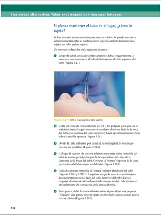 Vías aéreas alternativas: Tubos endotraqueales y máscaras laríngeas
Si planea mantener el tubo en el lugar, ¿cómo lo
sujeta?
Se han descrito varios métodos para sujetar el tubo. Se puede usar cinta
adhesiva impermeable o un dispositivo específicamente diseñado para
sujetar un tubo endotraqueal.
Un método se describe de la siguiente manera:
O Luego de haber colocado correctamente el tubo, tenga presente la
marca en centímetros en el lado del tubo junto al labio superior del
bebé (Figura 5.27).
Figura 5.2, Note la marca junto al labio superior.
0 Corte un trozo de cinta adhesiva de 3/4 o 1/2 pulgada para que sea lo
suficientemente largo como para extenderse desde un lado de la boca
del bebé, por encima del labio superior y hasta aproximadamente 2 cm
sobre la mejilla opuesta (Figura 5.28).
o Divida la cinta adhesiva por la mitad de su longitud de modo que
parezca un pantalón (Figura 5.28A).
© Coloque la sección de la cinta adhesiva sin cortar sobre la mejilla del
bebé de modo que el principio de la separación esté cerca de la
comisura de la boca del bebé. Coloque la “pierna” superior de la cinta
por encima del labio superior del bebé (Figura 5.28B).
0 Cuidadosamente envuelva la “pierna” inferior alrededor del tubo
(Figuras 5.28C y 5.28D). Asegúrese de que la marca en centímetros
deseada permanezca al lado del labio superior del bebé. Es fácil
empujar el tubo más de lo deseado de manera inadvertida durante el
procedimiento de colocación de la cinta adhesiva.
o En la punta, doble la cinta adhesiva sobre sí para dejar una pequeña
“lengüeta” que pueda sostener para desenrollar la cinta cuando quiera
retirar el tubo (Figura 5.28E).
136
ERRNVPHGLFRVRUJ
 