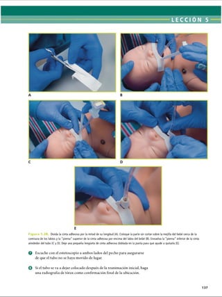 LECCI ÓN 5
F i g u r a 5.2 Divida la cinta adhesiva por la mitad de su longitud (A). Coloque la parte sin cortar sobre la mejilla del bebé cerca de la
comisura de los labios y la pierna” superior de la cinta adhesiva por encima del labio del bebé (B). Envuelva la pierna inferior de la cinta
alrededor del tubo (C y D). Deje una pequeña lengüeta de cinta adhesiva doblada en la punta para que ayude a quitarla (E).
o Escuche con el estetoscopio a ambos lados del pecho para asegurarse
de que el tubo no se haya movido de lugar.
o Si el tubo se va a dejar colocado después de la reanimación inicial, haga
una radiografía de tórax como confirmación final de la ubicación.
137
ERRNVPHGLFRVRUJ
 
