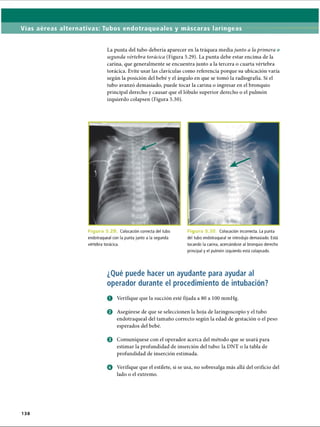 Vías aéreas alternativas: Tubos endotraqueales y máscaras laríngeas
La punta del tubo debería aparecer en la tráquea media junto a la primera o
segunda vértebra torácica (Figura 5.29). La punta debe estar encima de la
carina, que generalmente se encuentra junto a la tercera o cuarta vértebra
torácica. Evite usar las clavículas como referencia porque su ubicación varía
según la posición del bebé y el ángulo en que se tomó la radiografía. Si el
tubo avanzó demasiado, puede tocar la carina o ingresar en el bronquio
principal derecho y causar que el lóbulo superior derecho o el pulmón
izquierdo colapsen (Figura 5.30).
F i g u r a 5 . i Colocación correcta del tubo
endotraqueal con la punta junto a la segunda
vértebra torácica.
F i g u r a 5 .3 0 . Colocación incorrecta. La punta
del tubo endotraqueal se introdujo demasiado. Está
tocando la carina, acercándose al bronquio derecho
principal y el pulmón izquierdo está colapsado.
¿Qué puede hacer un ayudante para ayudar al
operador durante el procedimiento de intubación?
O Verifique que la succión esté fijada a 80 a 100 mmHg.
0 Asegúrese de que se seleccionen la hoja de laringoscopio y el tubo
endotraqueal del tamaño correcto según la edad de gestación o el peso
esperados del bebé.
0 Comuniqúese con el operador acerca del método que se usará para
estimar la profundidad de inserción del tubo: la DNT o la tabla de
profundidad de inserción estimada.
© Verifique que el estilete, si se usa, no sobresalga más allá del orificio del
lado o el extremo.
138
ERRNVPHGLFRVRUJ
 