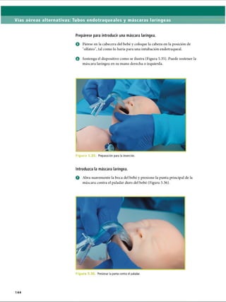Vías aéreas alternativas: Tubos endotraqueales y máscaras laríngeas
Prepárese para introducir una máscara laríngea.
0 Párese en la cabecera del bebé y coloque la cabeza en la posición de
olfateo, tal como lo haría para una intubación endotraqueal.
O Sostenga el dispositivo como se ilustra (Figura 5.35). Puede sostener la
máscara laríngea en su mano derecha o izquierda.
F i g u r d 5. Preparación para la inserción.
Introduzca la máscara laríngea.
O Abra suavemente la boca del bebé y presione la punta principal de la
máscara contra el paladar duro del bebé (Figura 5.36).
F i g u Presionar la punta contra el paladar.
144
ERRNVPHGLFRVRUJ
 