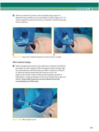 LECCI ÓN 5
O Mientras mantiene la presión contra el paladar, haga avanzar el
dispositivo hacia adentro con un movimiento circular (Figura 5.37). La
máscara seguirá el contorno de la boca y el paladar. Continúe hasta que
sienta resistencia.
F ig u r a 5 .3 7 Haga avanzar el dispositivo siguiendo el contorno de la boca y el paladar.
Infle la máscara laríngea.
O Infle el manguito inyectando el aire suficiente en el puerto de inflación
para lograr un sello. Luego de inflar el manguito, quite la jeringa. Siga
las recomendaciones del fabricante para inflar al máximo el volumen.
La inflación máxima demostrada de la máscara es de 5 mi
(Figura 5.38). Puede evaluar la inflación del manguito mirando el
balón piloto. La máscara laríngea se moverá un poquito hacia afuera al
inflarla. Nunca infle la máscara con más volumen de aire del
recomendado por el fabricante.
F ig u r a 5 Inflar el manguito con aire.
145
ERRNVPHGLFRVRUJ
 