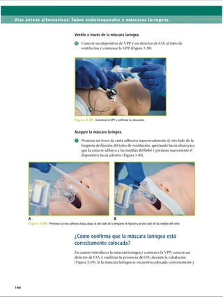 Vías aéreas alternativas: Tubos endotraqueales y máscaras laríngeas
Ventile a través de la máscara laríngea.
© Conecte un dispositivo de VPP y un detector de C 02al tubo de
ventilación y comience la VPP (Figura 5.39).
F ig u r a 5. Comenzar la VPP y confirmar la colocación.
Asegure la máscara laríngea.
o Presione un trozo de cinta adhesiva transversalmente al otro lado de la
lengüeta de fijación del tubo de ventilación, apretando hacia abajo para
que la cinta se adhiera a las mejillas del bebé y presione suavemente el
dispositivo hacia adentro (Figura 5.40).
F ig u r a 5 Presionar la cinta adhesiva hacia abajo al otro lado de la lengüeta de fijación y al otro lado de las mejillas del bebé.
¿Cómo confirma que la máscara laríngea está
correctamente colocada?
En cuanto introduzca la máscara laríngea y comience la VPP, conecte un
detector de C 02y confirme la presencia de C 02durante la exhalación
(Figura 5.39). Si la máscara laríngea se encuentra colocada correctamente y
146
ERRNVPHGLFRVRUJ
 