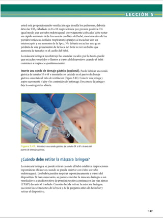 usted está proporcionando ventilación que insufla los pulmones, debería
detectar CO? exhalado en 8 a 10 respiraciones por presión positiva. De
igual modo que un tubo endotraqueal correctamente colocado, debe notar
un rápido aumento de la frecuencia cardíaca del bebé, movimientos de las
paredes torácicas, sonidos respiratorios parejos al escuchar con un
estetoscopio y un aumento de la Spo2. No debería escuchar una gran
pérdida de aire proveniente de la boca del bebé ni ver un bulto que
aumenta de tamaño en el cuello del bebé.
La máscara laríngea no obstruye las cuerdas vocales; por lo tanto, puede
que escuche resoplidos o llantos a través del dispositivo cuando el bebé
comience a respirar espontáneamente.
Inserte una sonda de drenaje gástrico (opcional). Puede lubricar una sonda
gástrica de tamaño 5F o 6F e insertarla con cuidado en el puerto de drenaje
gástrico conectado al tubo de ventilación (Figura 5.41). Conecte una jeringa y
aspire suavemente el aire y los contenidos del estómago. Desconecte la jeringa y
deje la sonda gástrica abierta.
Fie Introducir una sonda gástrica de tamaño 5F o 6F a través del
puerto de drenaje gástrico.
¿Cuándo debe retirar la máscara laríngea?
La máscara laríngea se puede retirar cuando el bebé establece respiraciones
espontáneas eficaces o cuando se pueda insertar con éxito un tubo
endotraqueal. Los bebés pueden respirar espontáneamente a través del
dispositivo. Si fuera necesario, se puede conectar la máscara laríngea a un
ventilador o a un dispositivo de presión positiva continua en las vías aéreas
(CPAP) durante el traslado. Cuando decida retirar la máscara laríngea,
succione las secreciones de la boca y de la garganta antes de desinflar y
retirar el dispositivo.
ERRNVPHGLFRVRUJ
 